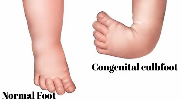 What is Clubfoot?