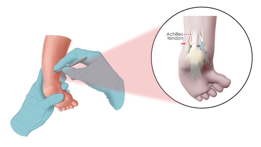 Clubfoot Treatment: Achilles Tenotomy (Percutaneous)