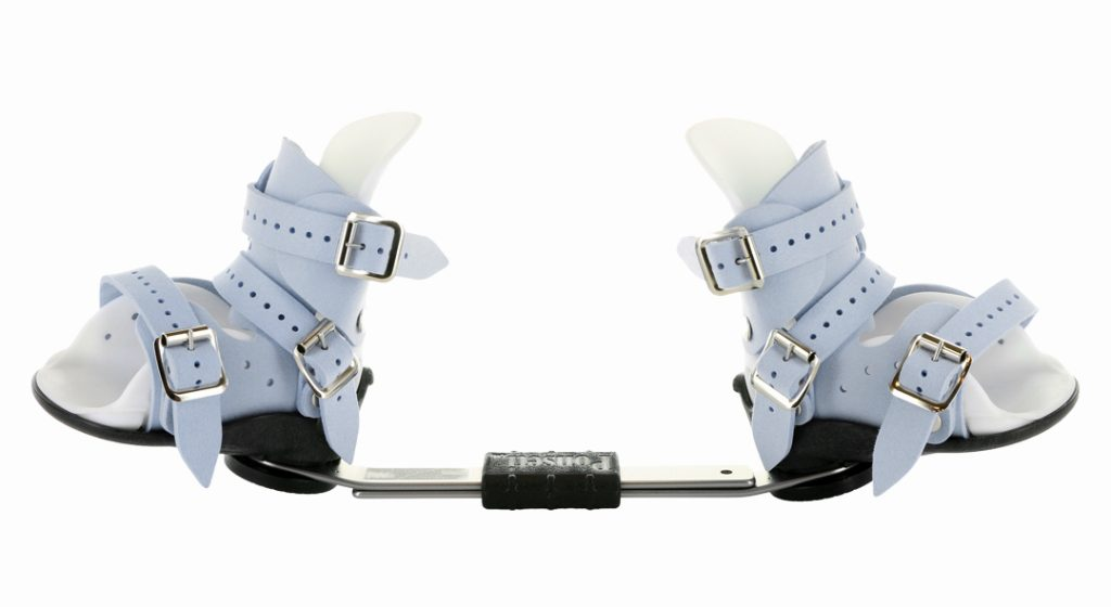 Clubfoot Treatment: Bracing (Maintenance Phase)