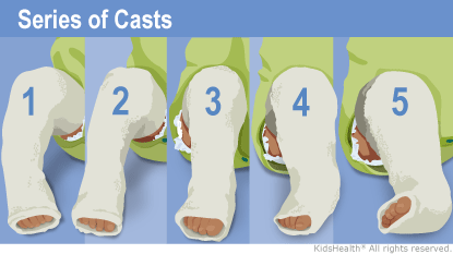 Clubfoot Treatment: Serial Casting